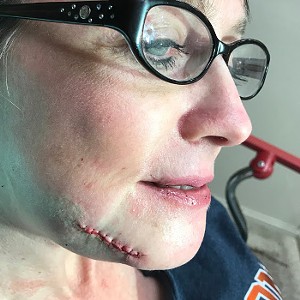 Nabors' jaw after being sewed-up, as captured by her doctor at Memorial Hermann hospital. - PHOTO PROVIDED BY TRACY NABORS