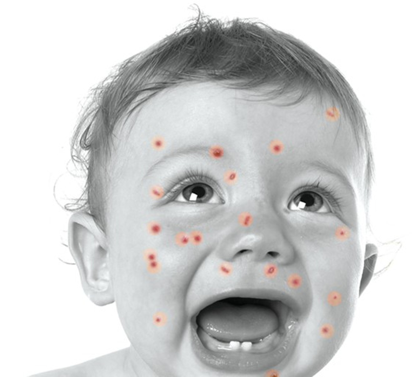 Measles isn't the worst that can happen.